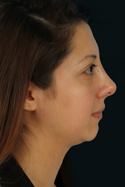 Before & Afters Before & After Gallery - Patient 106848 - Image 2