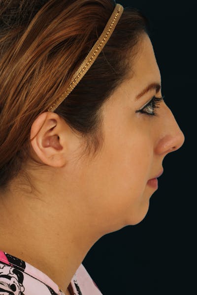 Before & Afters Before & After Gallery - Patient 106848 - Image 1