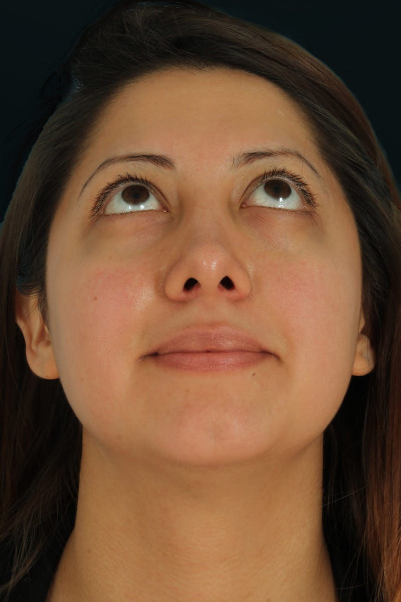 Before & Afters Before & After Gallery - Patient 106848 - Image 8