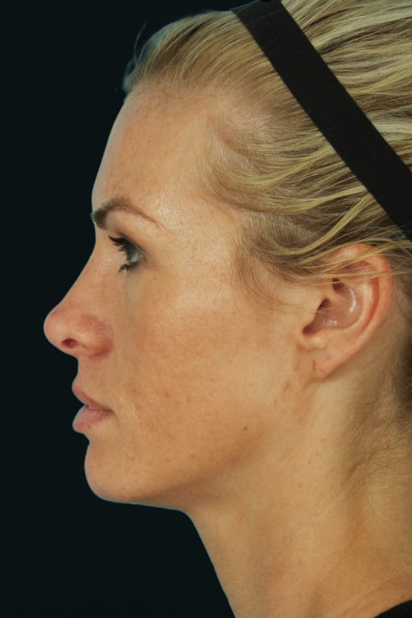 Before & Afters Before & After Gallery - Patient 219015 - Image 2