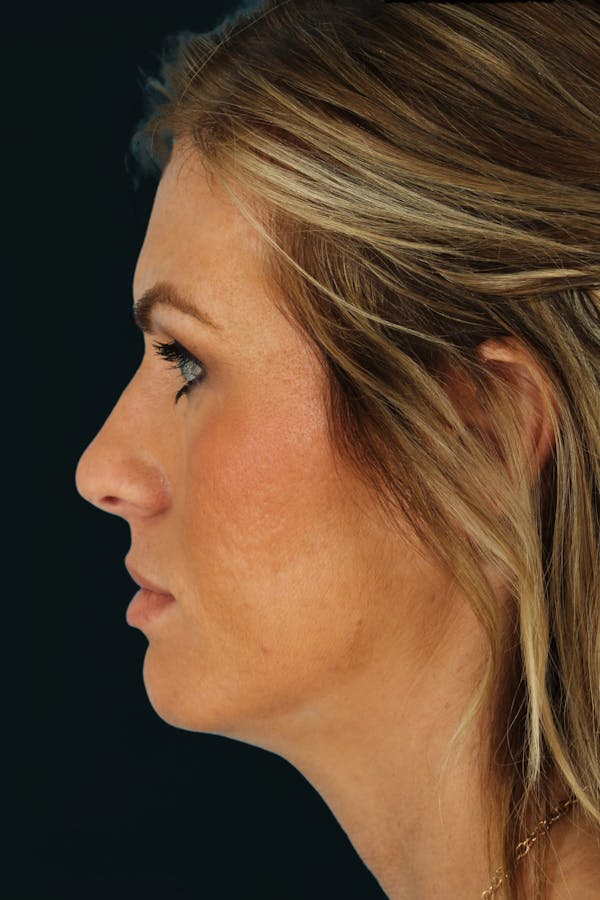 Before & Afters Before & After Gallery - Patient 219015 - Image 1