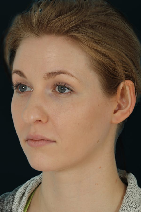 Before & Afters Before & After Gallery - Patient 312274 - Image 1