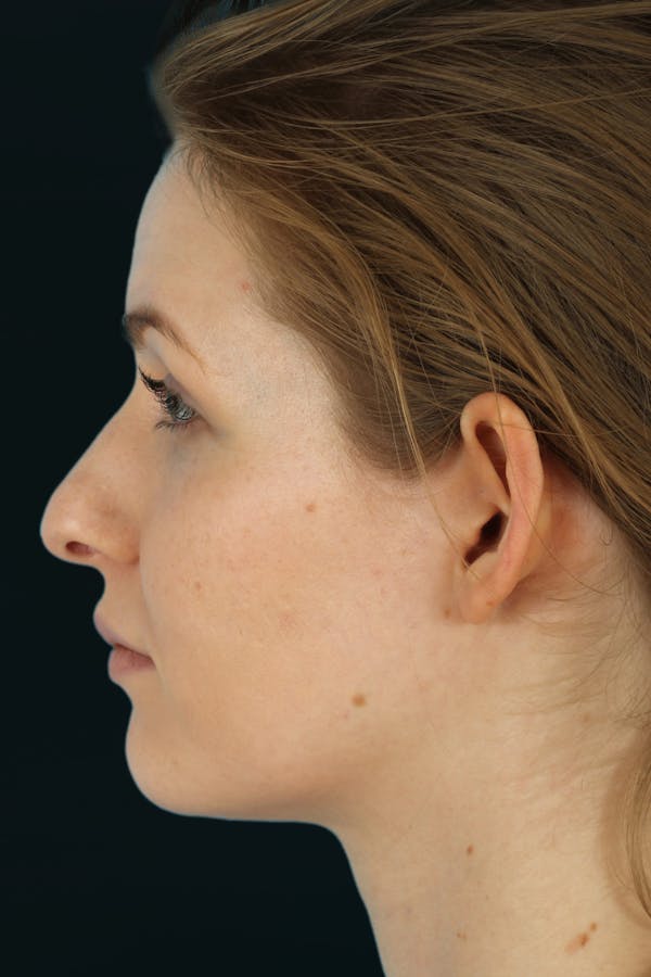 Before & Afters Before & After Gallery - Patient 312274 - Image 2