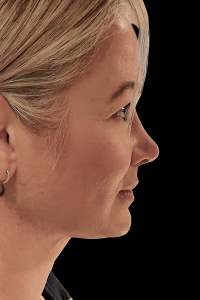 Before & Afters Before & After Gallery - Patient 400145 - Image 2