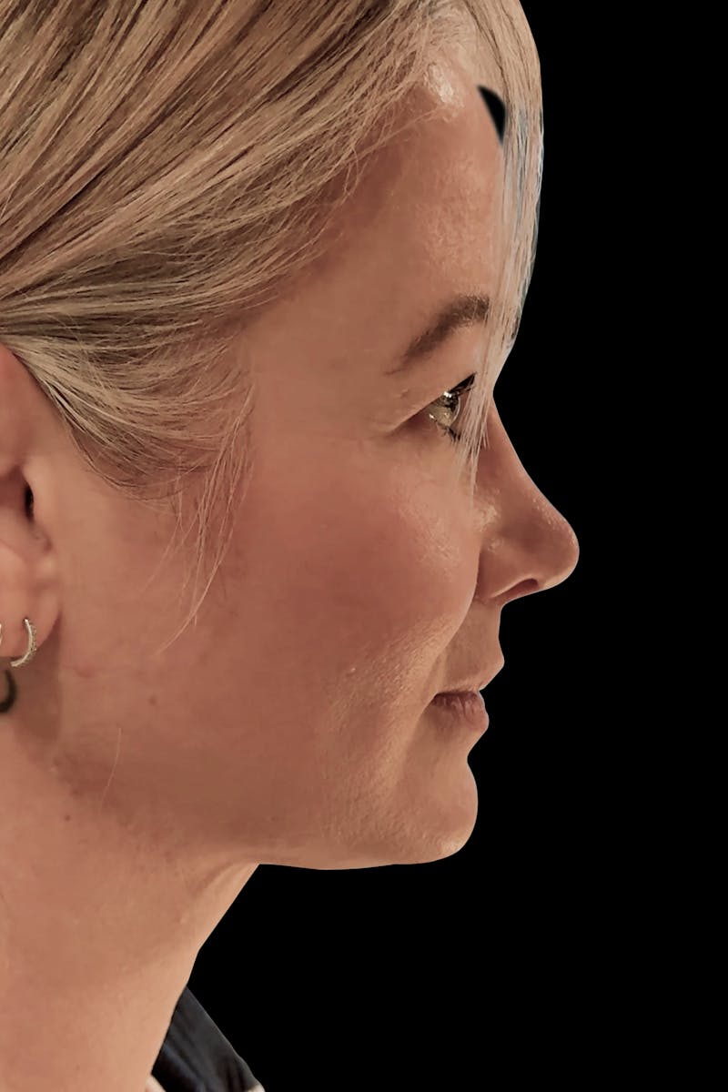 Before & Afters Before & After Gallery - Patient 400145 - Image 2