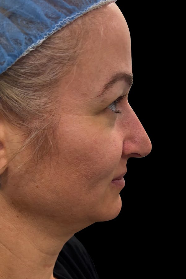 Before & Afters Before & After Gallery - Patient 400145 - Image 1