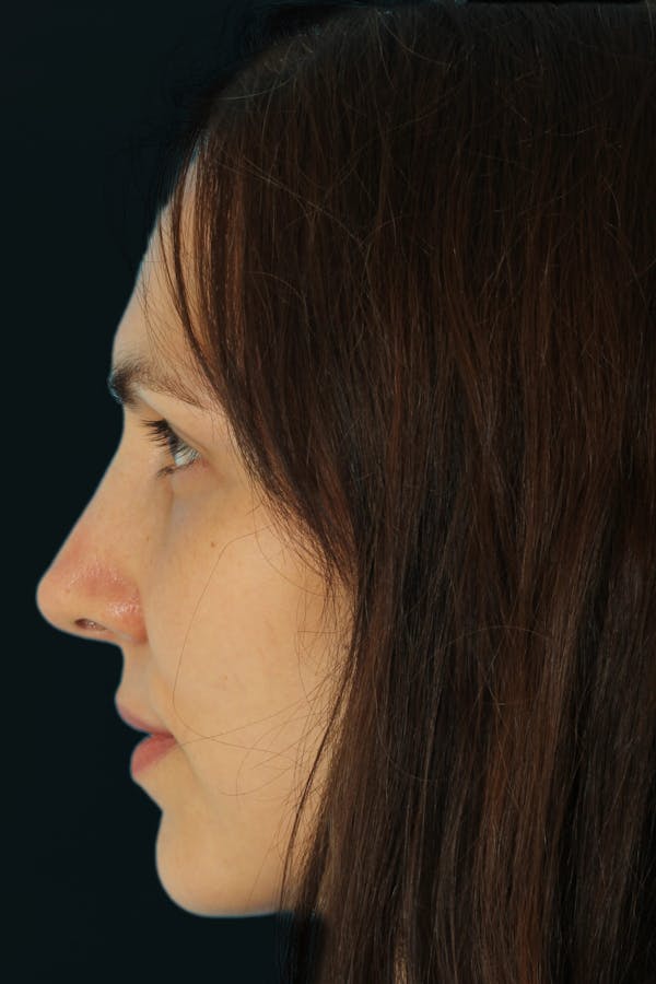 Before & Afters Before & After Gallery - Patient 209541 - Image 2