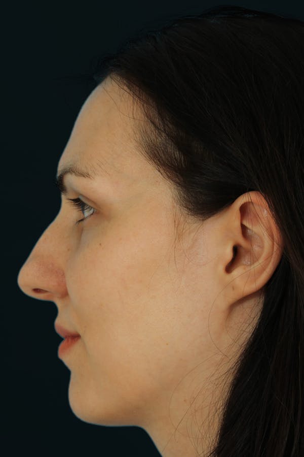 Before & Afters Before & After Gallery - Patient 209541 - Image 1