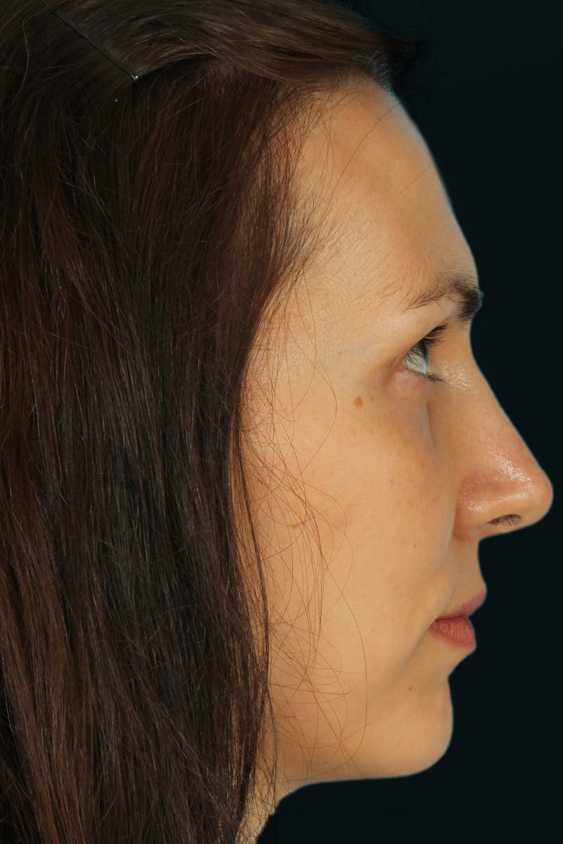 Before & Afters Before & After Gallery - Patient 209541 - Image 10