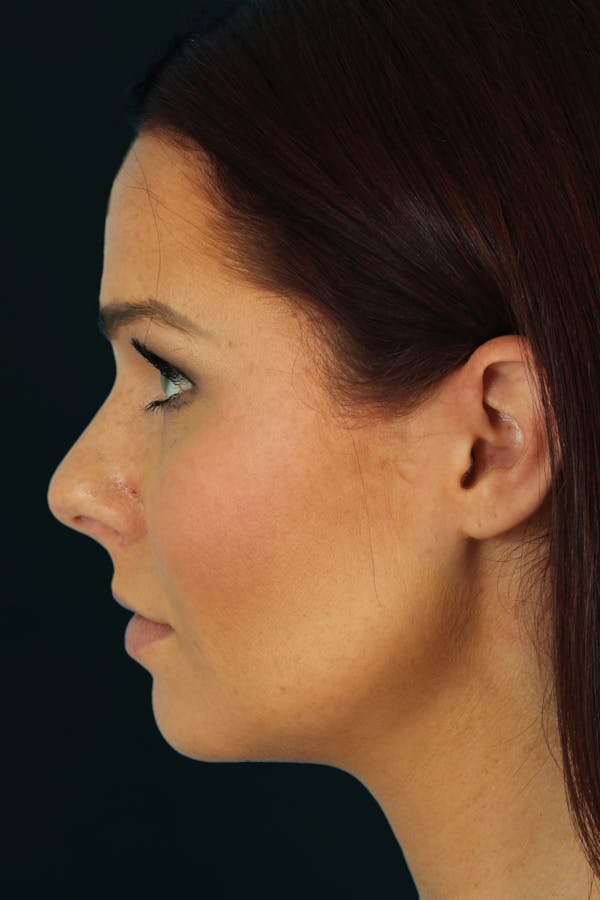 Before & Afters Before & After Gallery - Patient 260759 - Image 1