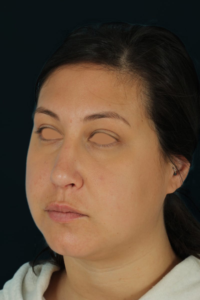Before & Afters Before & After Gallery - Patient 238761 - Image 2