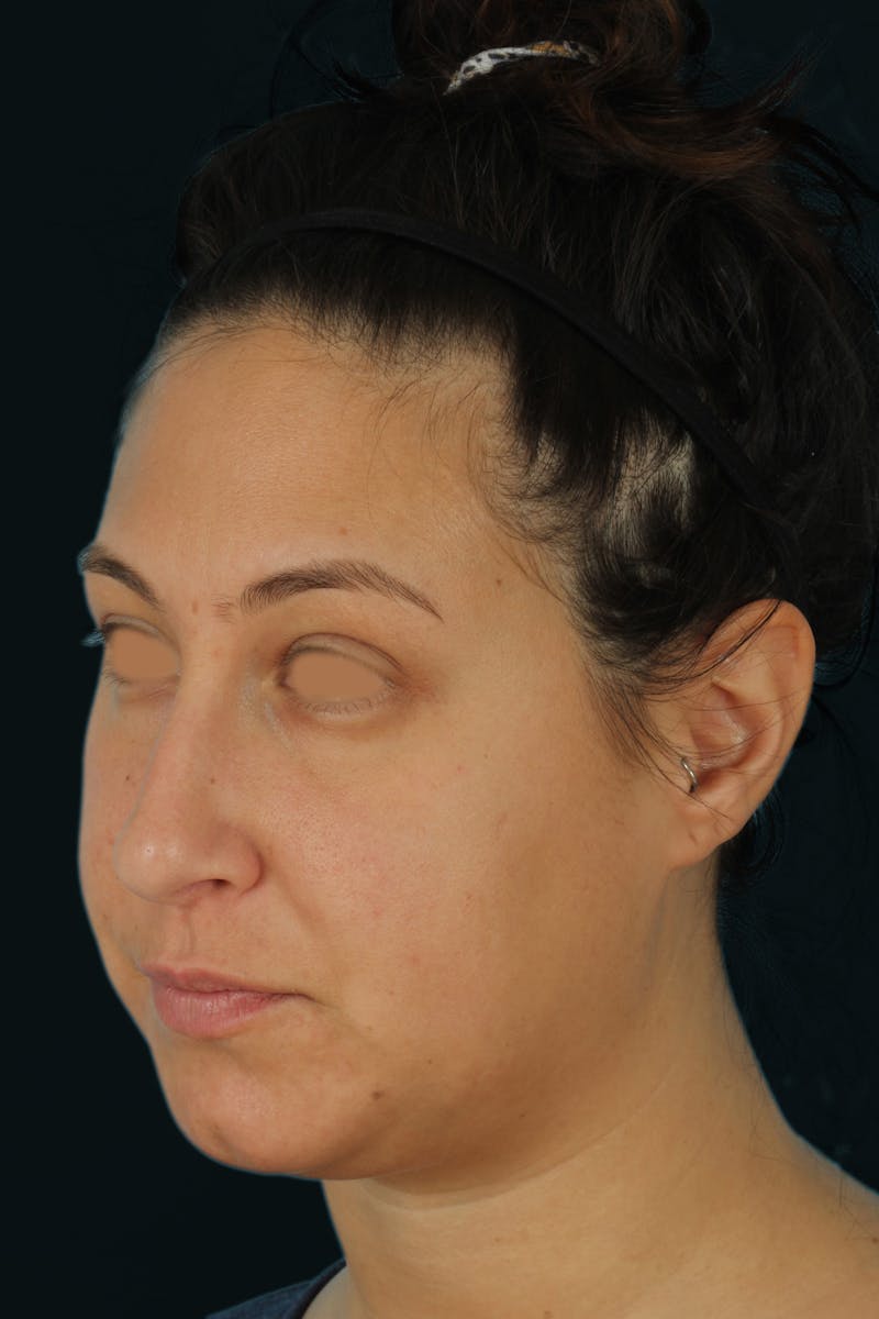 Before & Afters Before & After Gallery - Patient 238761 - Image 1