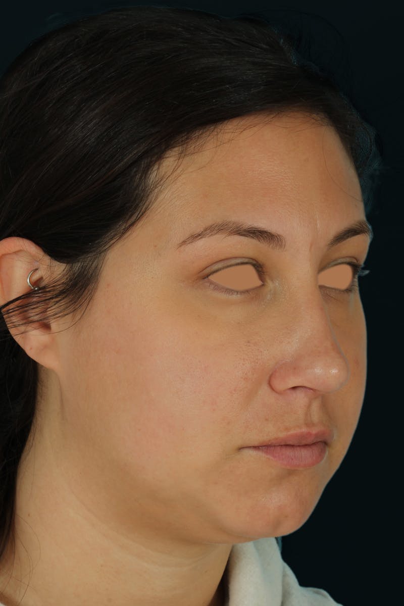 Before & Afters Before & After Gallery - Patient 238761 - Image 4