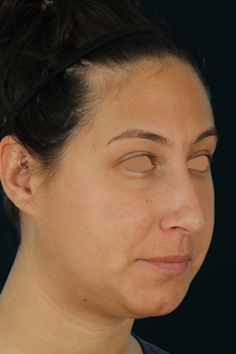 Before & Afters Before & After Gallery - Patient 238761 - Image 3