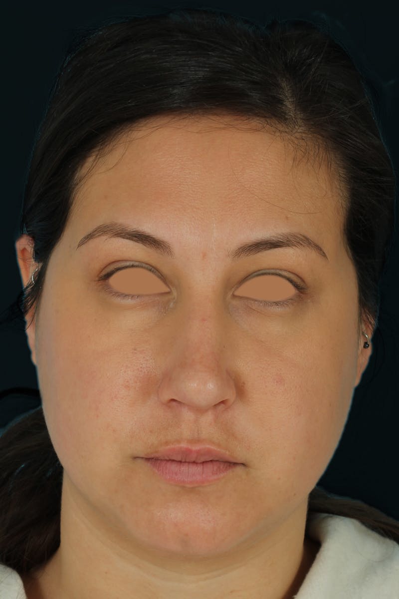 Before & Afters Before & After Gallery - Patient 238761 - Image 6