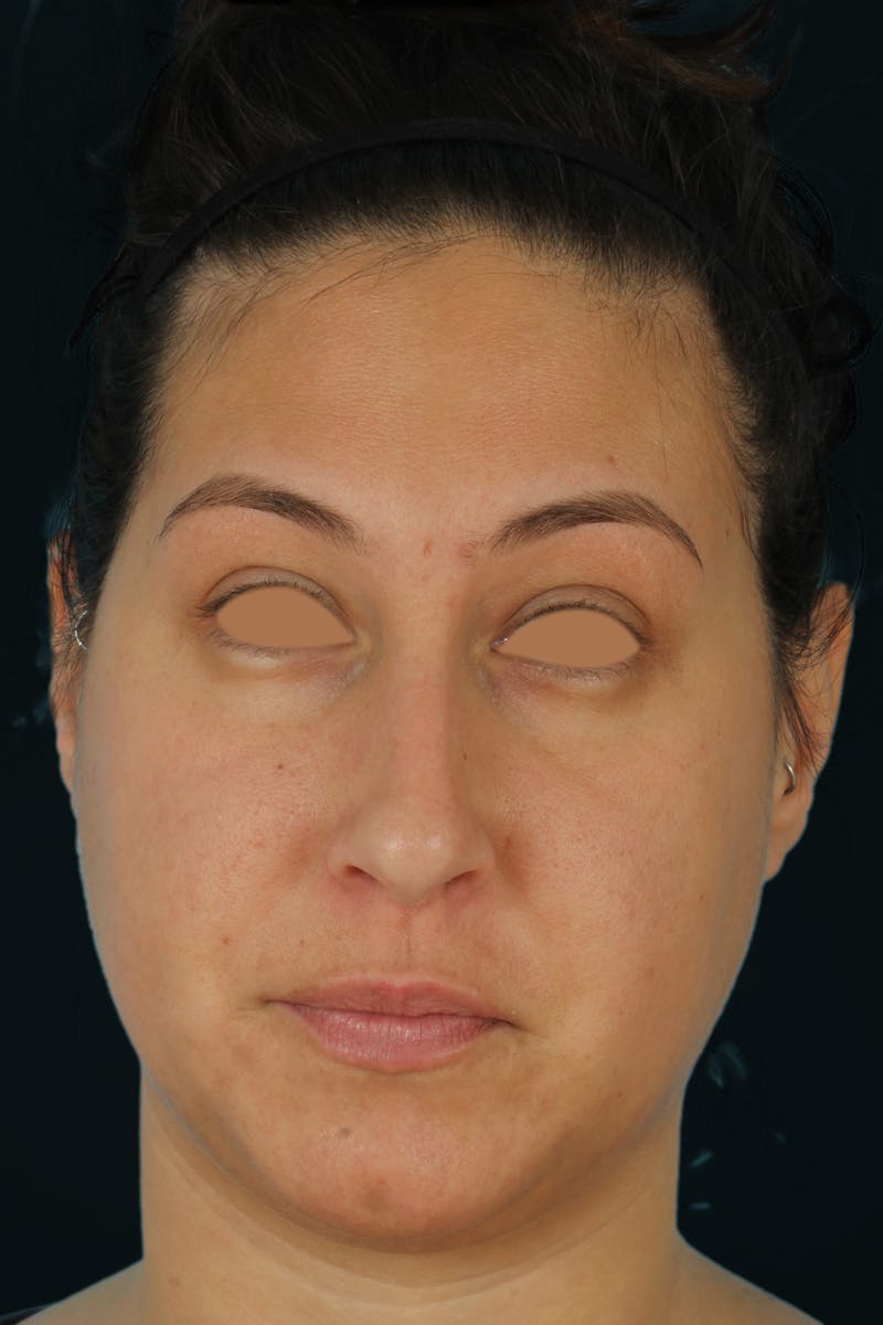 Before & Afters Before & After Gallery - Patient 238761 - Image 5