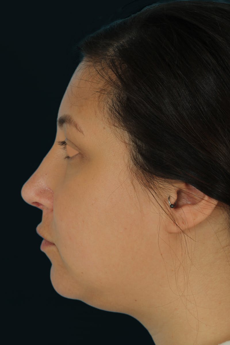 Before & Afters Before & After Gallery - Patient 238761 - Image 8