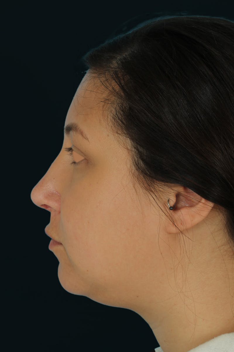 Before & Afters Before & After Gallery - Patient 238761 - Image 7
