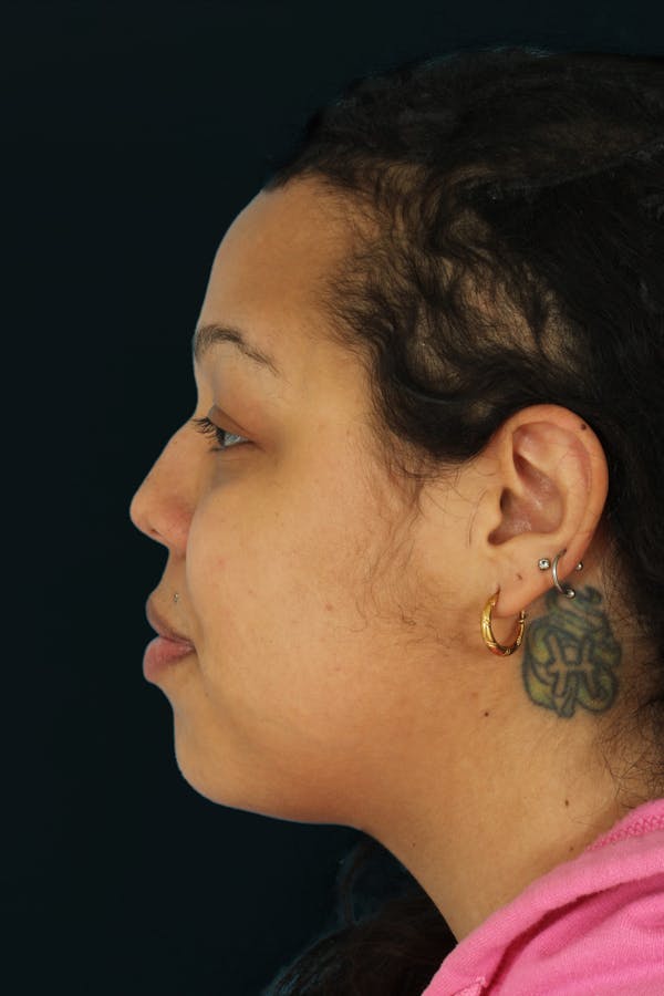 Before & Afters Before & After Gallery - Patient 100348 - Image 1