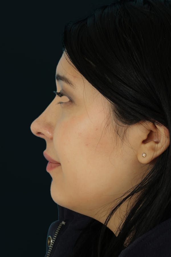 Before & Afters Before & After Gallery - Patient 387857 - Image 2