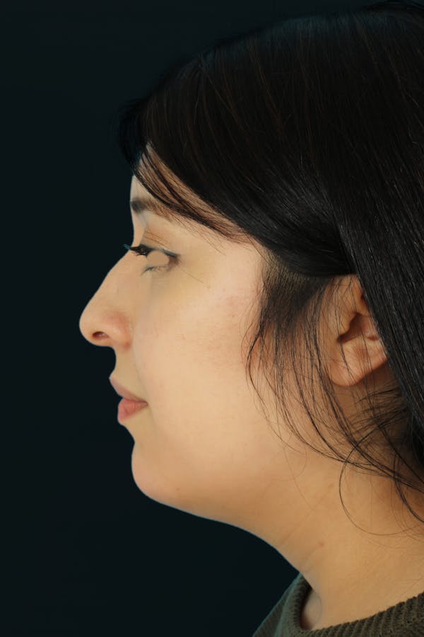 Before & Afters Before & After Gallery - Patient 387857 - Image 1