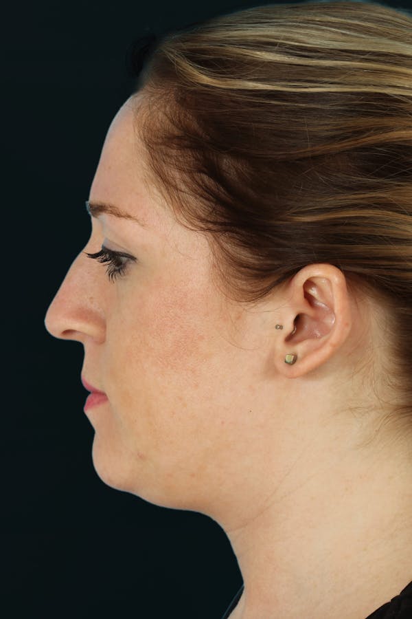Before & Afters Before & After Gallery - Patient 327701 - Image 1