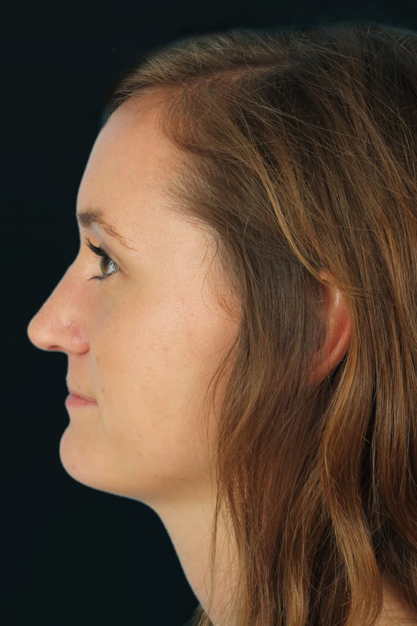 Before & Afters Before & After Gallery - Patient 652486 - Image 2