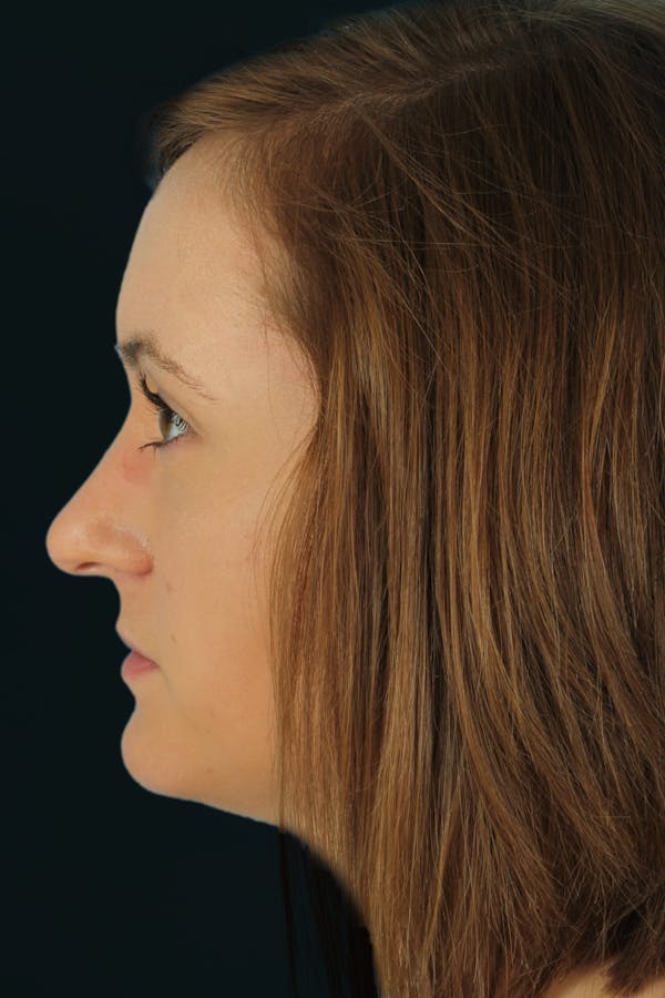 Before & Afters Before & After Gallery - Patient 652486 - Image 1