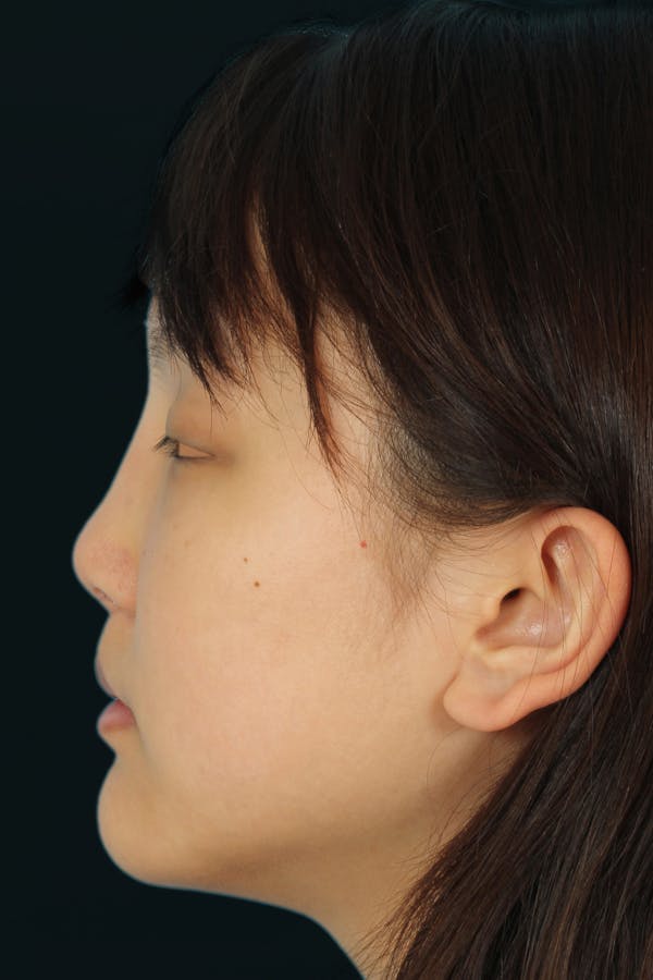 Before & Afters Before & After Gallery - Patient 134786 - Image 2