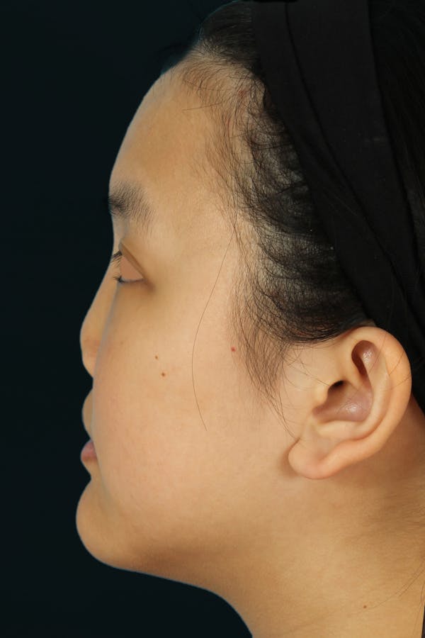 Before & Afters Before & After Gallery - Patient 134786 - Image 1