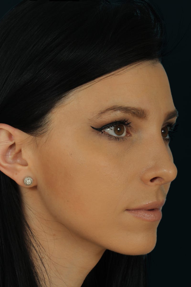 Before & Afters Before & After Gallery - Patient 400213 - Image 6