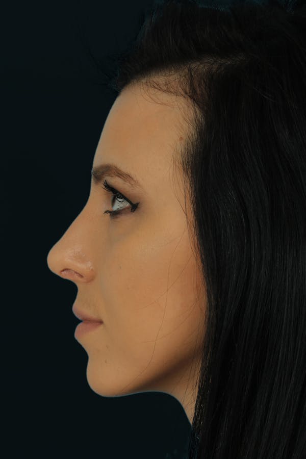 Before & Afters Before & After Gallery - Patient 400213 - Image 2