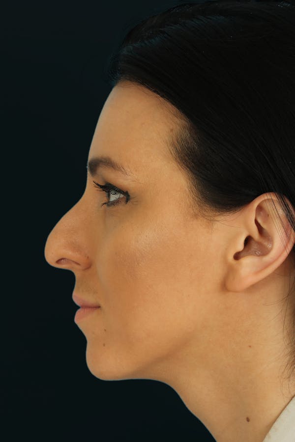 Before & Afters Before & After Gallery - Patient 400213 - Image 1