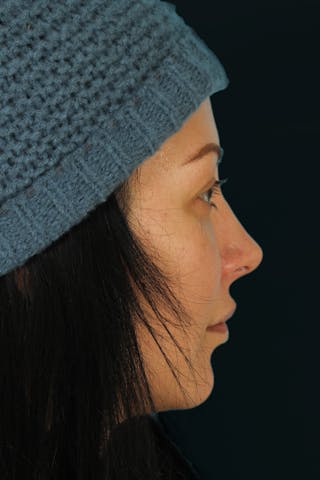 Before & Afters Before & After Gallery - Patient 544387 - Image 2