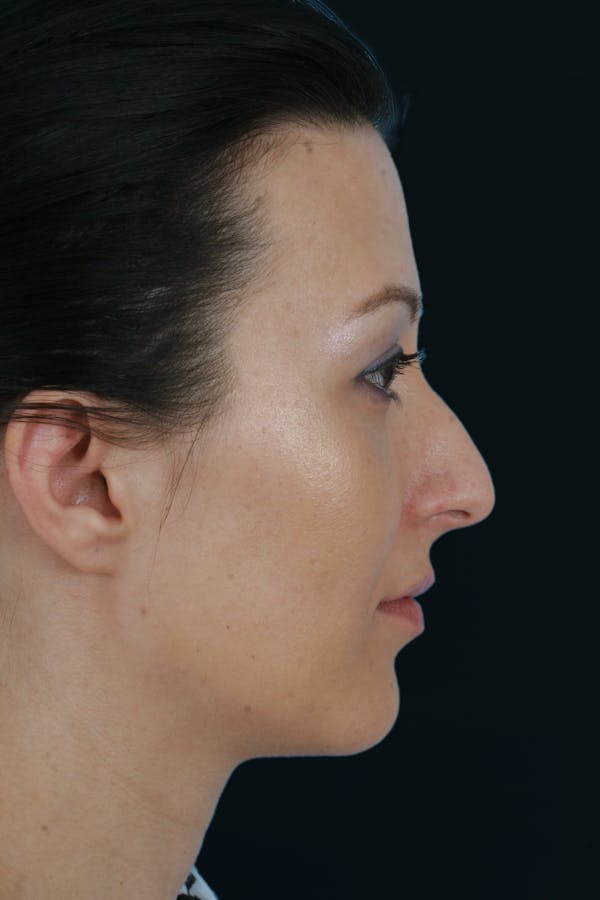 Before & Afters Before & After Gallery - Patient 544387 - Image 1
