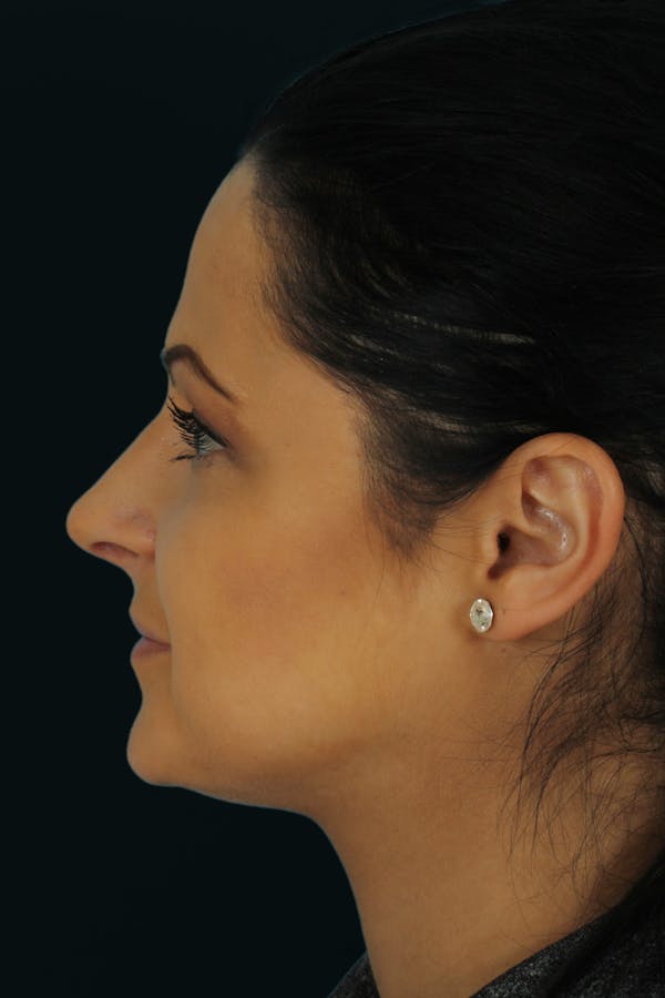 Before & Afters Before & After Gallery - Patient 984800 - Image 2