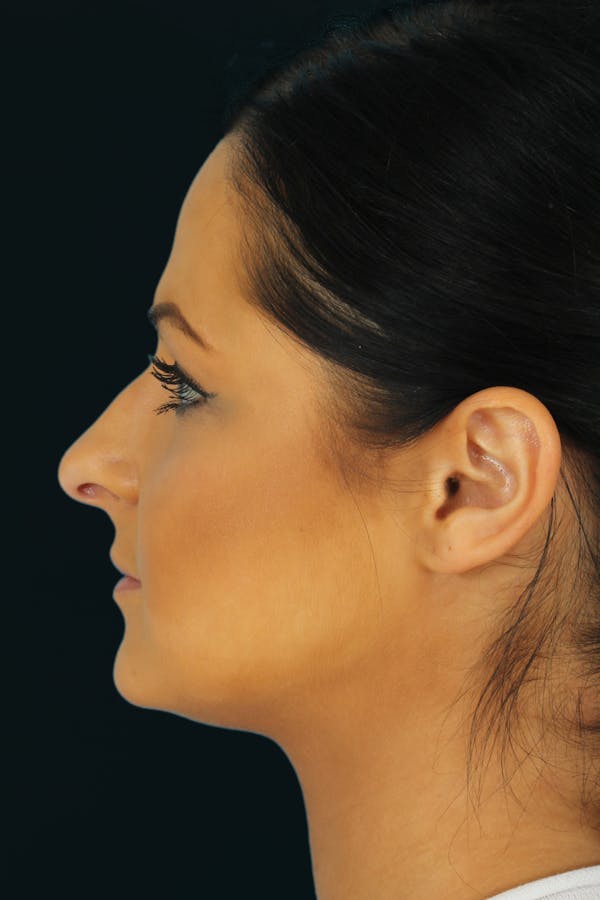 Before & Afters Before & After Gallery - Patient 984800 - Image 1