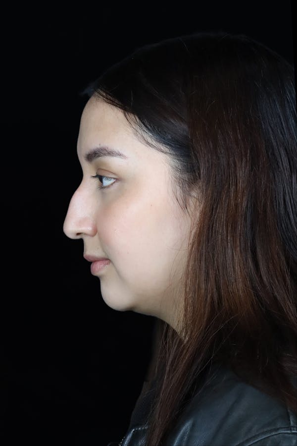 Before & Afters Before & After Gallery - Patient 326458 - Image 1