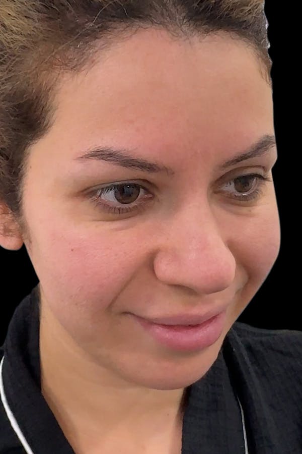 Before & Afters Before & After Gallery - Patient 661661 - Image 2