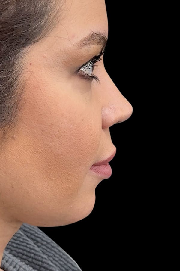 Before & Afters Before & After Gallery - Patient 661661 - Image 1