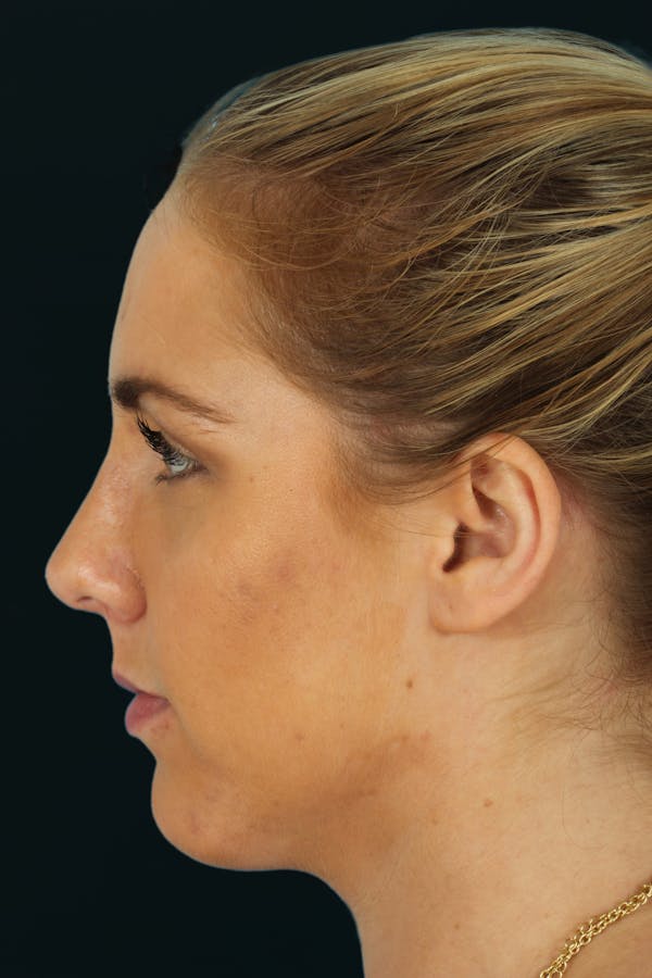 Before & Afters Before & After Gallery - Patient 354898 - Image 2