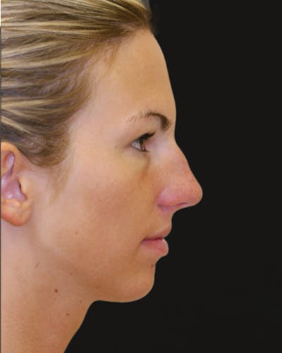 Before & Afters Before & After Gallery - Patient 409198 - Image 1