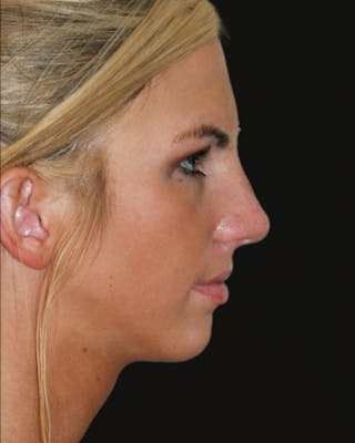 Before & Afters Before & After Gallery - Patient 409198 - Image 2