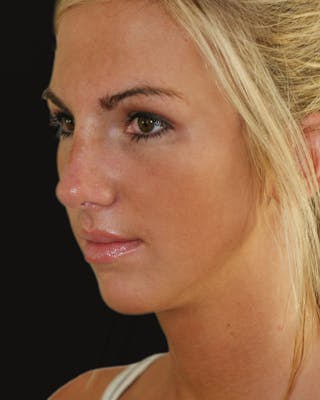 Before & Afters Before & After Gallery - Patient 409198 - Image 4