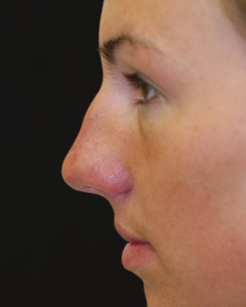 Before & Afters Before & After Gallery - Patient 409198 - Image 5