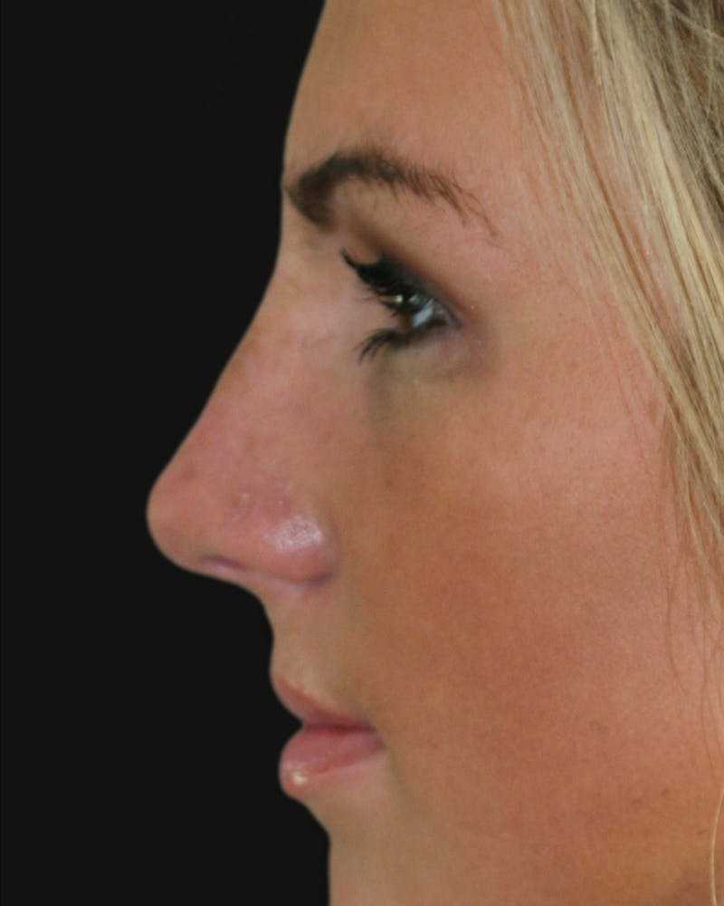 Before & Afters Before & After Gallery - Patient 409198 - Image 6