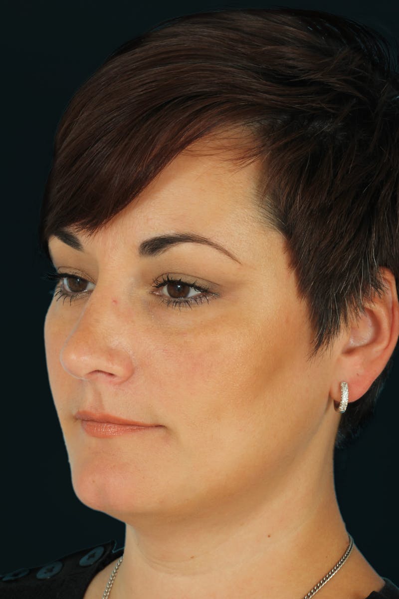 Before & Afters Before & After Gallery - Patient 289420 - Image 2