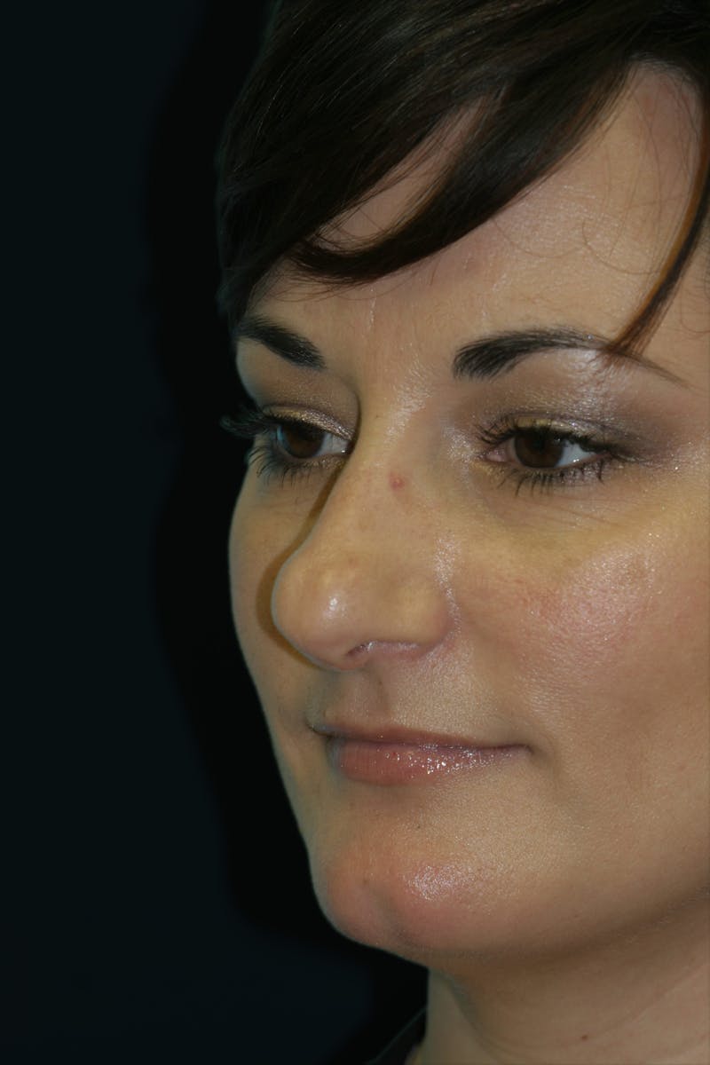 Before & Afters Before & After Gallery - Patient 289420 - Image 1