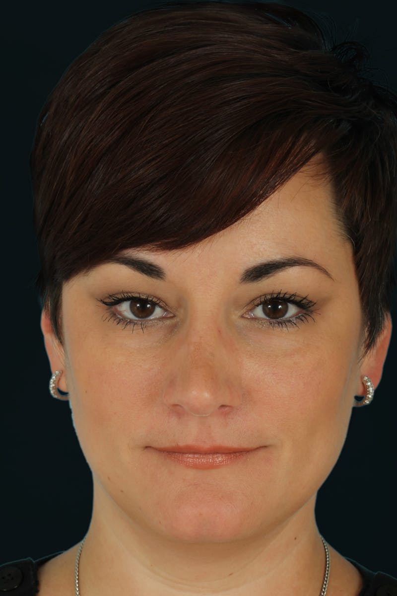 Before & Afters Before & After Gallery - Patient 289420 - Image 4