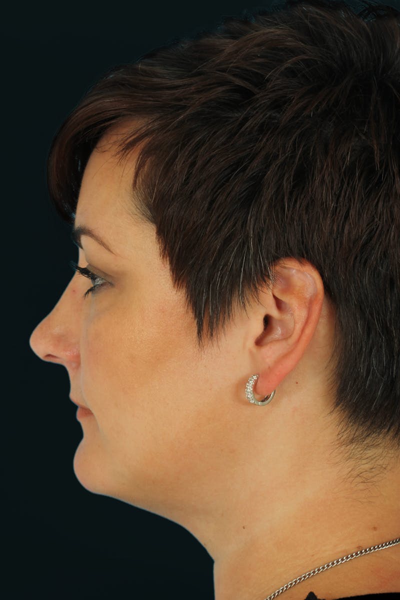Before & Afters Before & After Gallery - Patient 289420 - Image 6